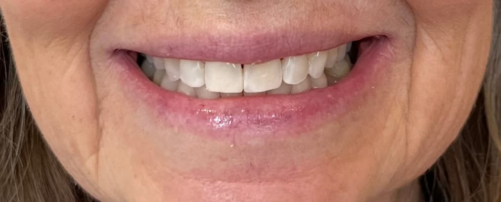 After Invisalign