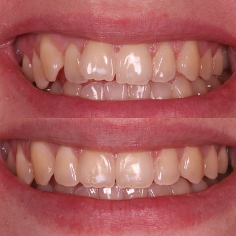 Invisalign<sup>&reg;</sup>
