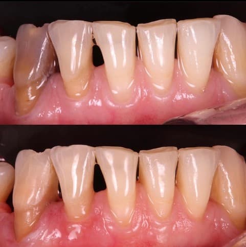 Internal whitening