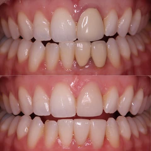 Gum treatment and smile makeover with new crowns