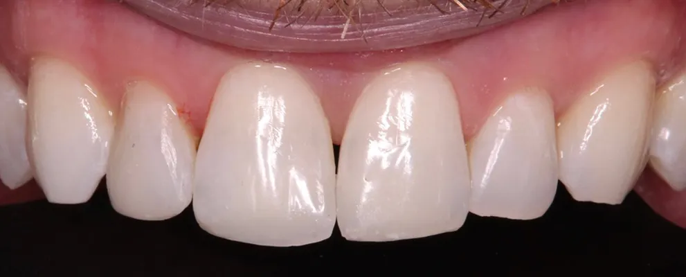 After Invisalign®