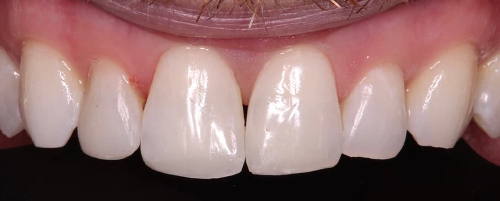 After Invisalign®