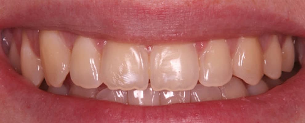 After Invisalign®