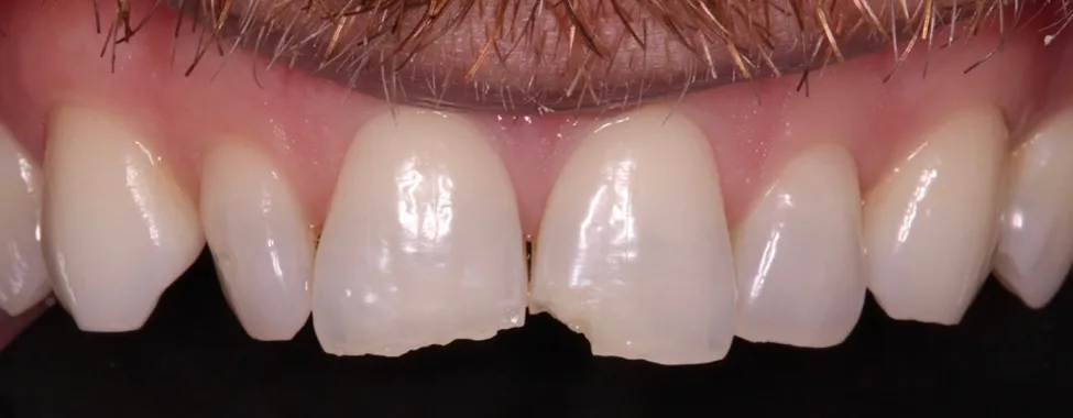 Before Invisalign®
