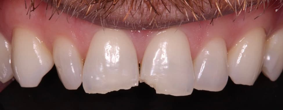 Before Invisalign®