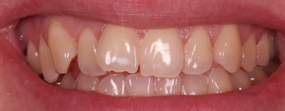 Before Invisalign®