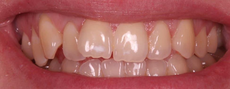 Before Invisalign®