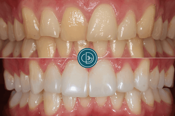 Who is Composite Bonding Suitable for?