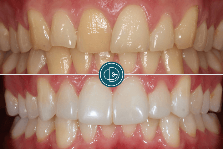 Who is Composite Bonding Suitable for?
