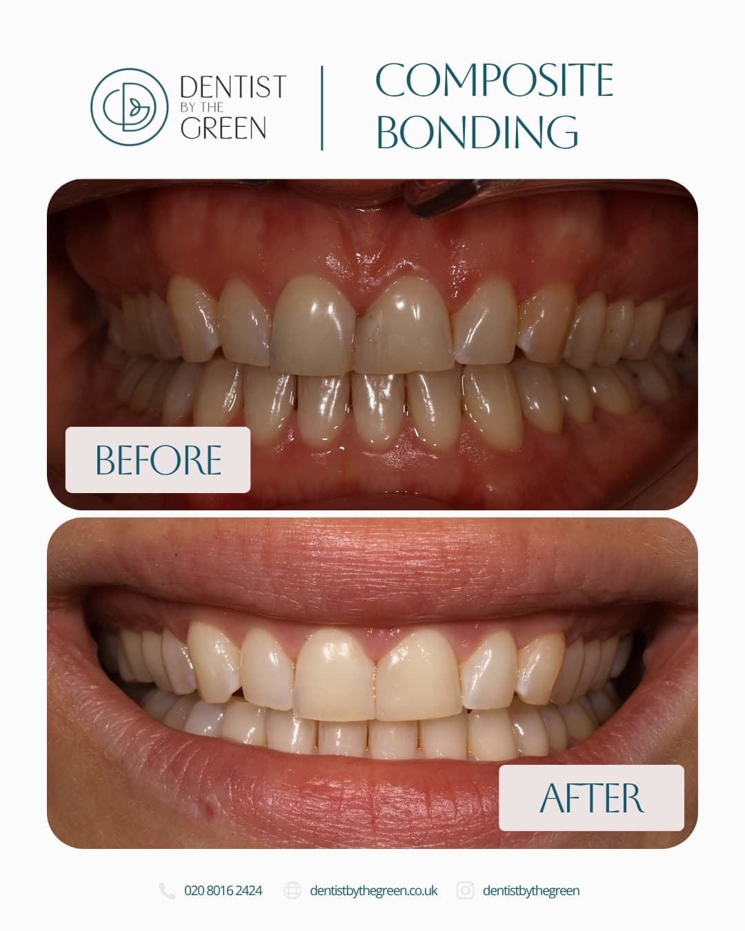 After Invisalign®