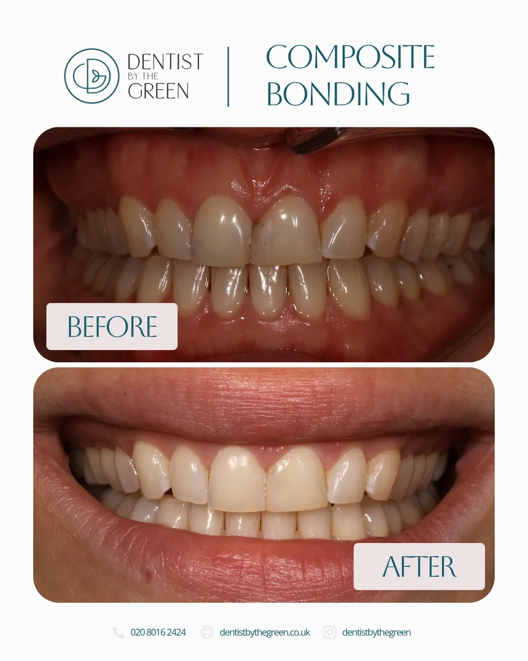 After Invisalign®